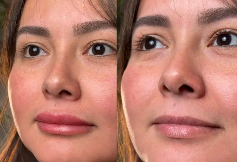 Dark Lip Neutralization before and after, Frenkel PMU House