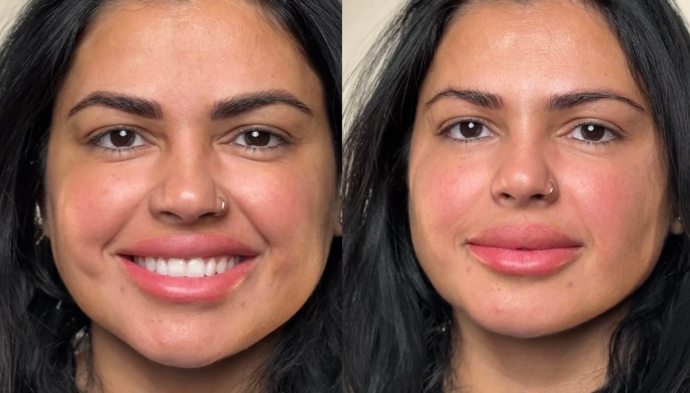 Lip Liner Enhancement before and after, Frenkel PMU House