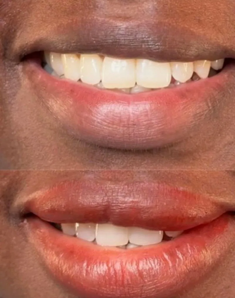 Dark Lip Neutralization before and after, client result 2, Leander TX