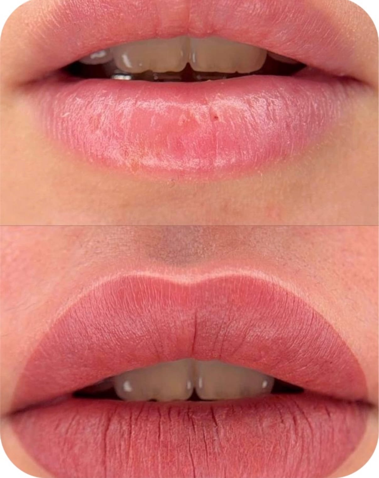 Dark Lip Neutralization before and after, Frenkel PMU House