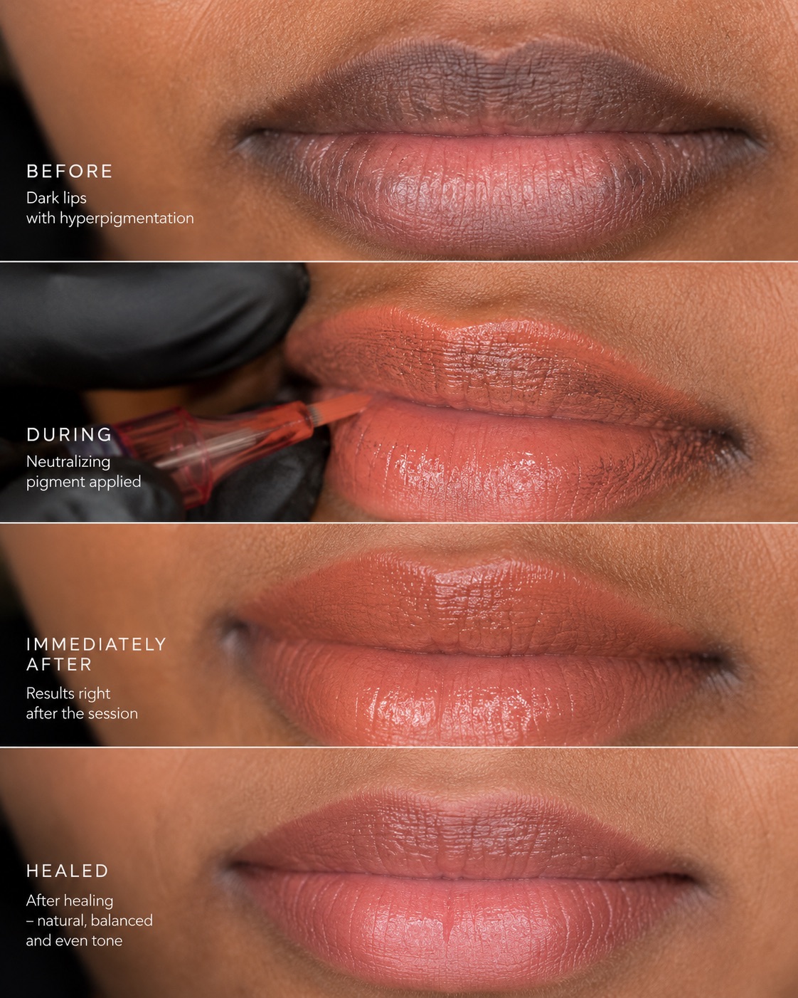 Dark Lip Neutralization result