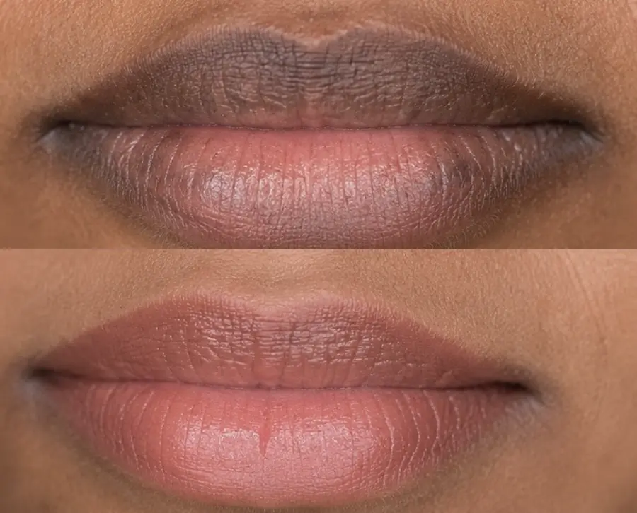 Healed dark lip neutralization in Leander TX
